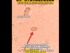 医生淘洗粪便3小时找到肝吸虫 微小虫卵大海捞针[推荐]